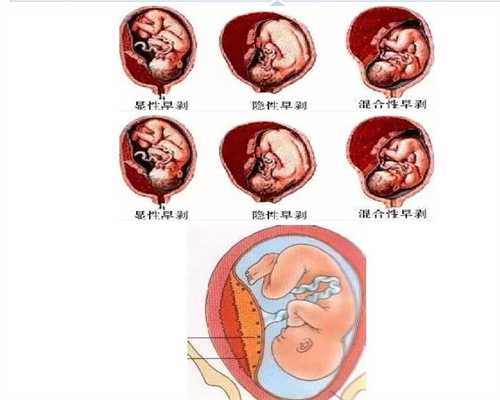 代孕需要多少费用_三个月宝宝发烧37.8