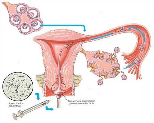 试管移植一个胚胎也会得双胎吗？