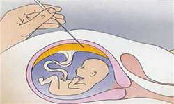 做试管遇到卵巢过度刺激综合征几率大吗？